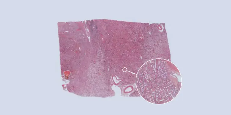 Renal Adenoma